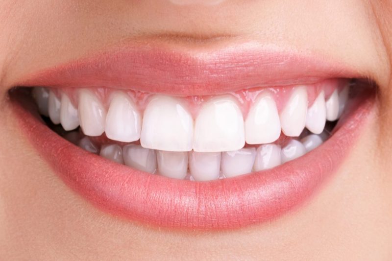 teeth-whitening-after-e1476360472614