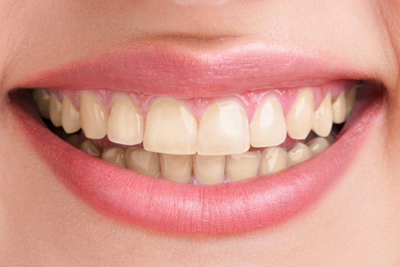 teeth-whitening-before-e1476360420607