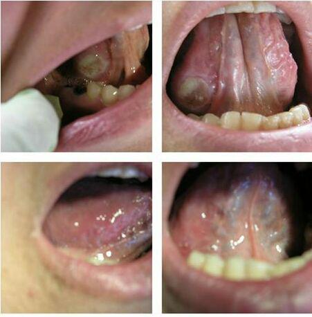 زخم زیر زبان قبل و پس از درمان