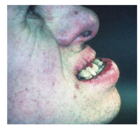 اختلالات دندانی و معلولیت