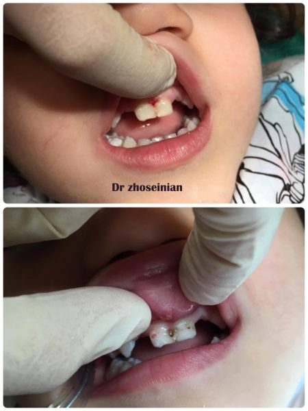 ترمیم دندان کودک