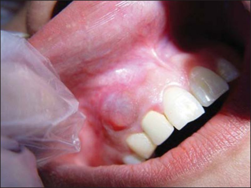 انواع کیست دندان