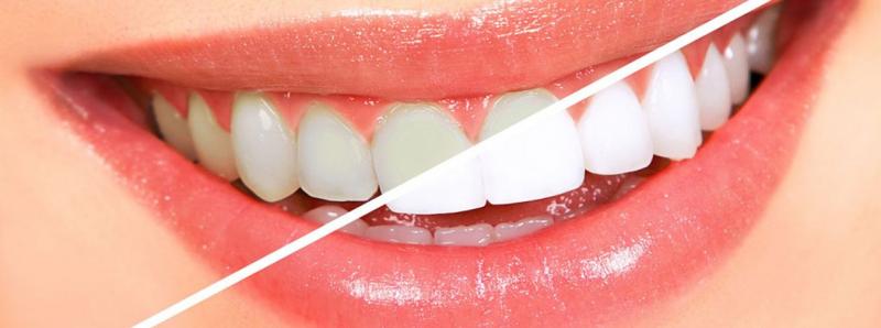 عوارض جانبی بلیچینگ دندان