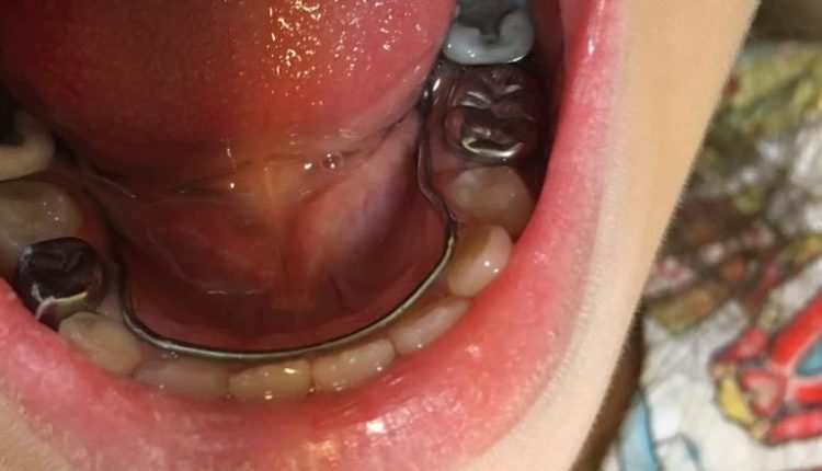فضانگهدار ثابت  فک پایین، مطب دندانپزشکی کودکان دکتر حسینیان