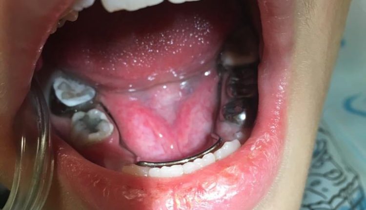 فضانگهدار ثابت دوطرفه فک پایین، مطب دندانپزشکی کودکان دکتر حسینیان