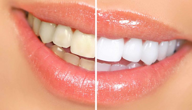 سفید کردن دندان یا بلیچینگ