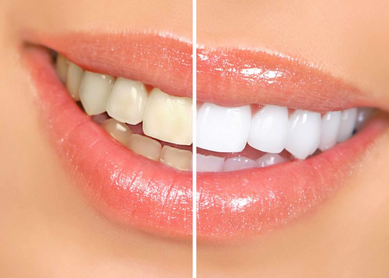سفید کردن دندان یا بلیچینگ